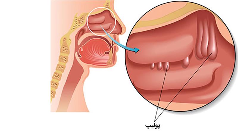 راه های درمان پولیپ بینی با عسل