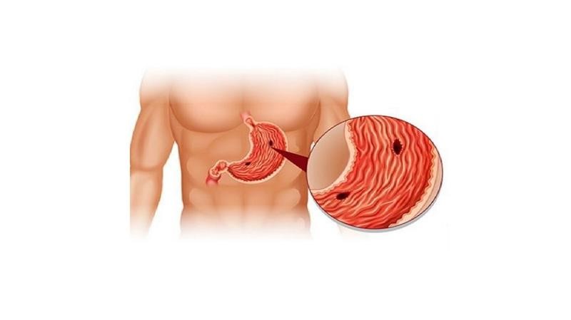 علائم زخم معده